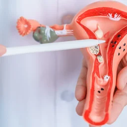 Endometriosis y fertilidad