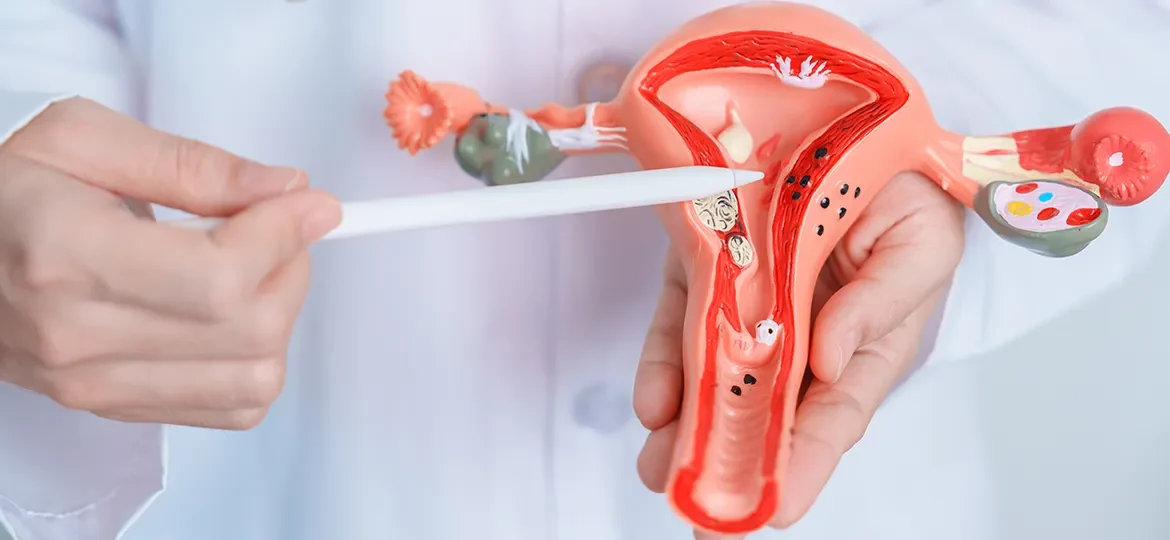Endometriosis y fertilidad