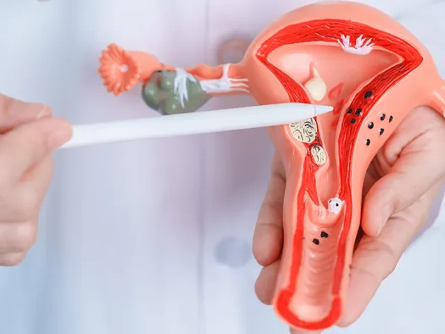 Endometriosis y fertilidad